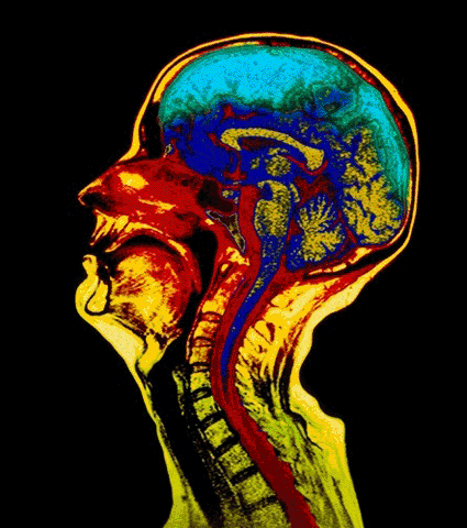Imagen: Examen de resonancia magnética a color (RM) de un corte sagital del cerebro de un hombre de 51 años de edad, mostrando atrofia cerebral (Foto cortesía de Simon Fraser / Royal Victoria Infirmary, Newcastle Upon Tyne / SPL).